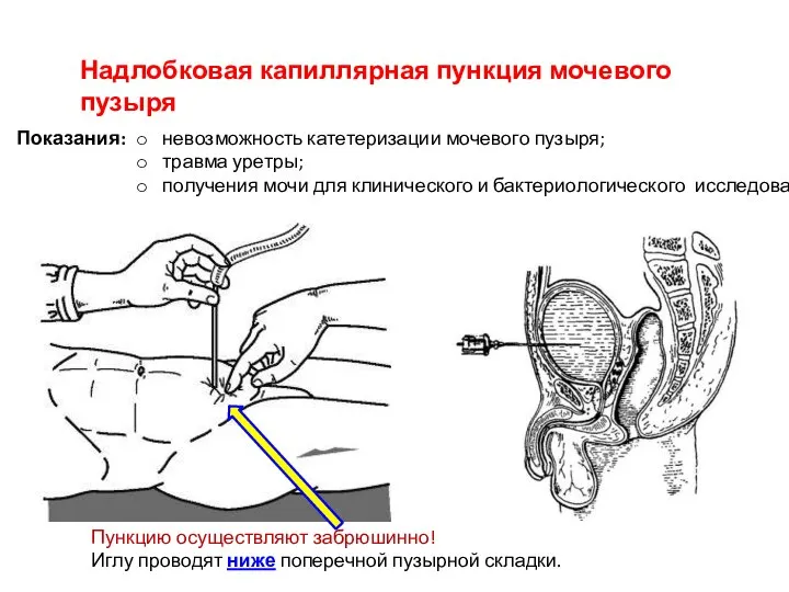 Надлобковая капиллярная пункция мочевого пузыря невозможность катетеризации мочевого пузыря; травма уретры; получения