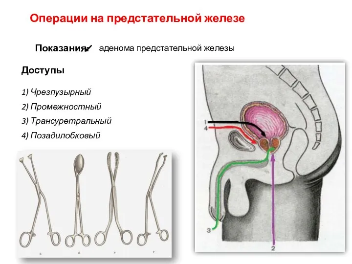 Операции на предстательной железе Показания: аденома предстательной железы Доступы 1) Чрезпузырный 2)
