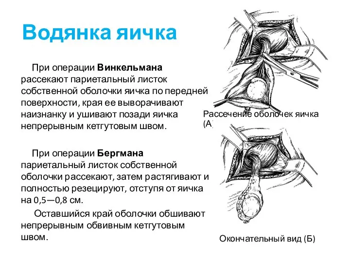 Водянка яичка При операции Винкельмана рассекают париетальный листок собственной оболочки яичка по