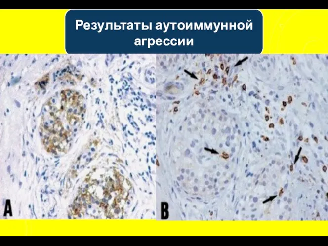 Результаты аутоиммунной агрессии