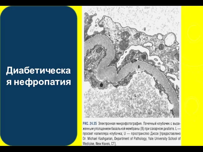 Диабетическая нефропатия