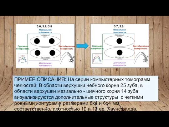 ПРИМЕР ОПИСАНИЯ: На серии компьютерных томограмм челюстей: В области верхушки небного корня