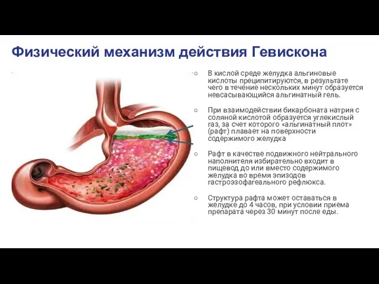 Физический механизм действия Гевискона В кислой среде желудка альгиновые кислоты преципитируются, в