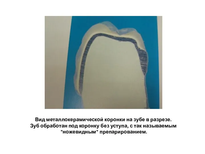 Вид металлокерамической коронки на зубе в разрезе. Зуб обработан под коронку без