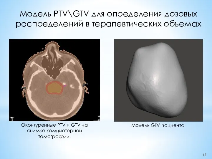 Модель PTV\GTV для определения дозовых распределений в терапевтических объемах Оконтуренные PTV и