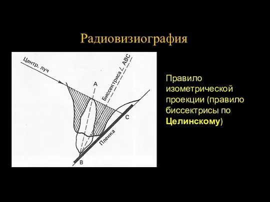 Радиовизиография Правило изометрической проекции (правило биссектрисы по Целинскому)