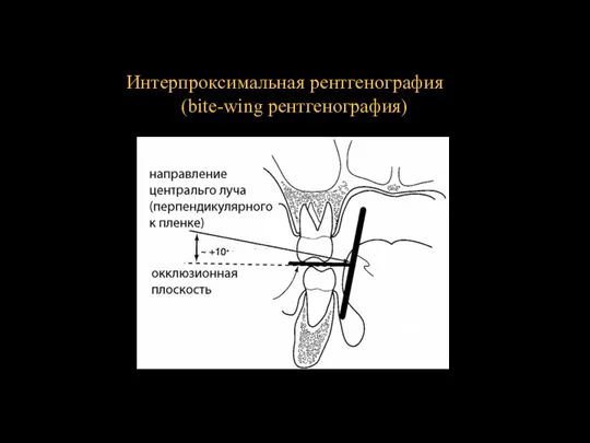 Интерпроксимальная рентгенография (bite-wing рентгенография)