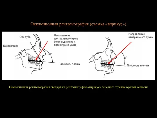 Окклюзионная рентгенография (съемка «вприкус») Окклюзионная рентгенография свода рта и рентгенография «вприкус» передних отделов верхней челюсти