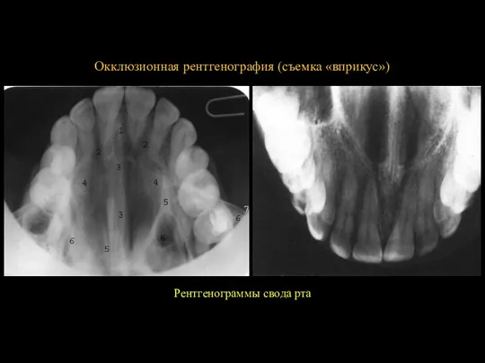 Окклюзионная рентгенография (съемка «вприкус») Рентгенограммы свода рта