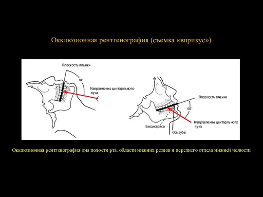 Окклюзионная рентгенография (съемка «вприкус») Окклюзионная рентгенография дна полости рта, области нижних резцов