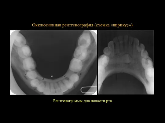 Окклюзионная рентгенография (съемка «вприкус») Рентгенограммы дна полости рта