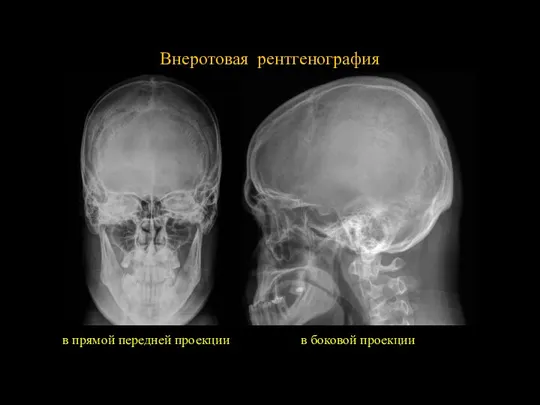 Внеротовая рентгенография в прямой передней проекции в боковой проекции