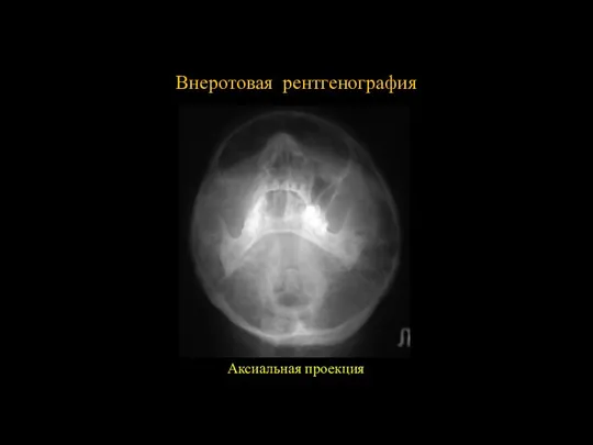 Внеротовая рентгенография Аксиальная проекция