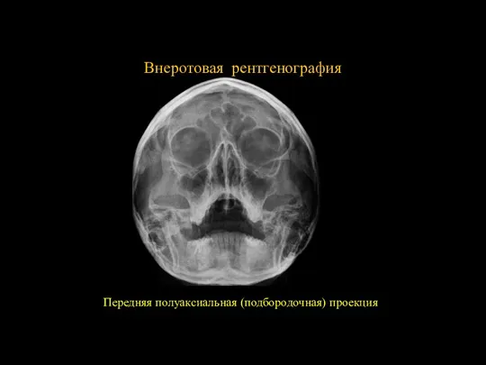 3 14 Внеротовая рентгенография Передняя полуаксиальная (подбородочная) проекция