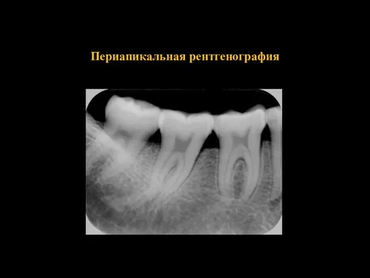 Периапикальная рентгенография