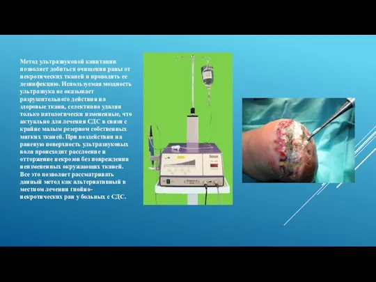 Метод ультразвуковой кавитации позволяет добиться очищения раны от некротических тканей и проводить