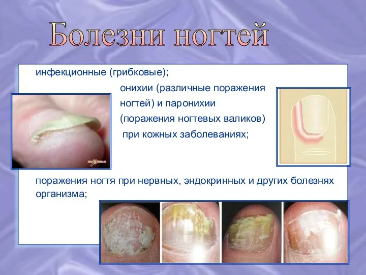 инфекционные (грибковые); онихии (различные поражения ногтей) и паронихии (поражения ногтевых валиков) при