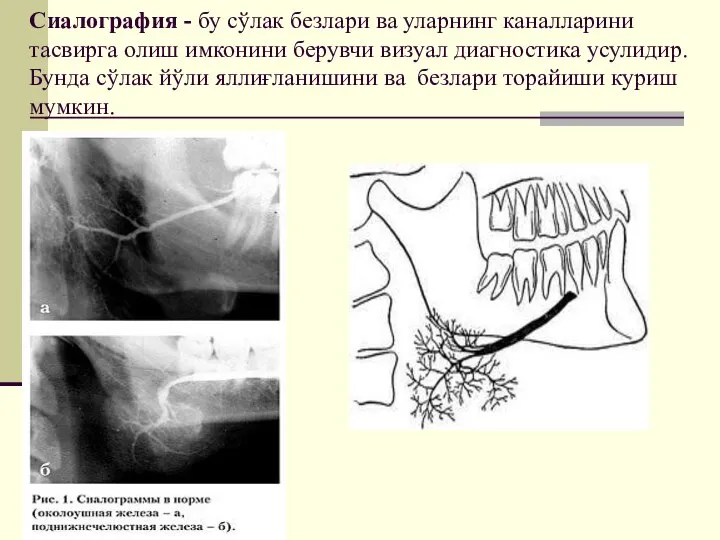 Сиалография - бу сўлак безлари ва уларнинг каналларини тасвирга олиш имконини берувчи