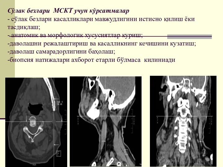 Сўлак безлари МСКТ учун кўрсатмалар - сўлак безлари касалликлари мавжудлигини истисно қилиш