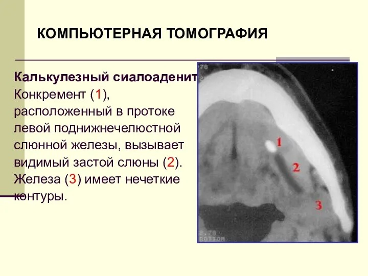 КОМПЬЮТЕРНАЯ ТОМОГРАФИЯ Калькулезный сиалоаденит Конкремент (1), расположенный в протоке левой поднижнечелюстной слюнной