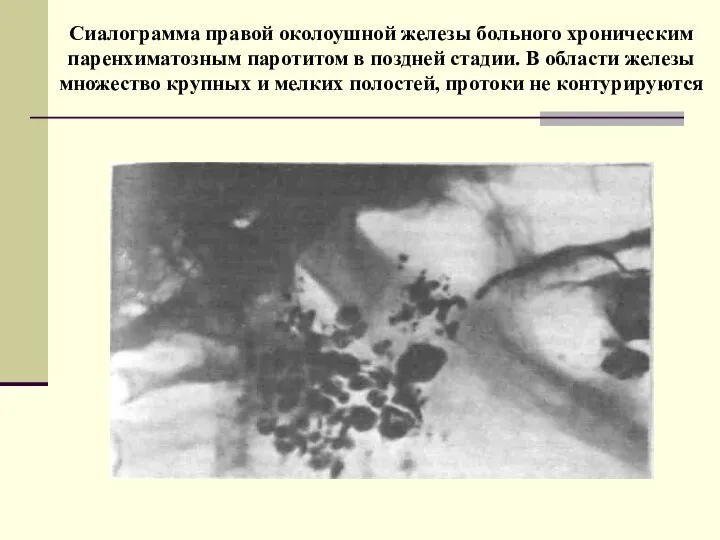 Сиалограмма правой околоушной железы больного хроническим паренхиматозным паротитом в поздней стадии. В