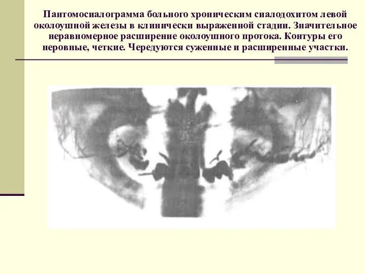 Пантомосиалограмма больного хроническим сиалодохитом левой околоушной железы в клинически выраженной стадии. Значительное