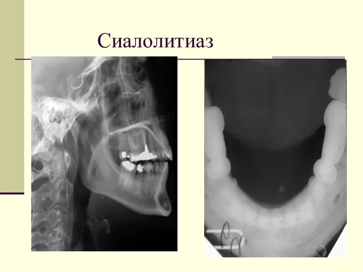 Сиалолитиаз