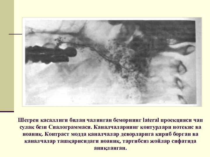 Шегрен касаллиги билан чалинган беморнинг lateral проекцияси чап сулак бези Сиалограммаси. Каналчаларнинг