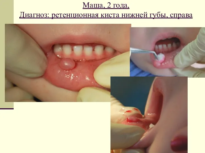 Маша, 2 года, Диагноз: ретенционная киста нижней губы, справа