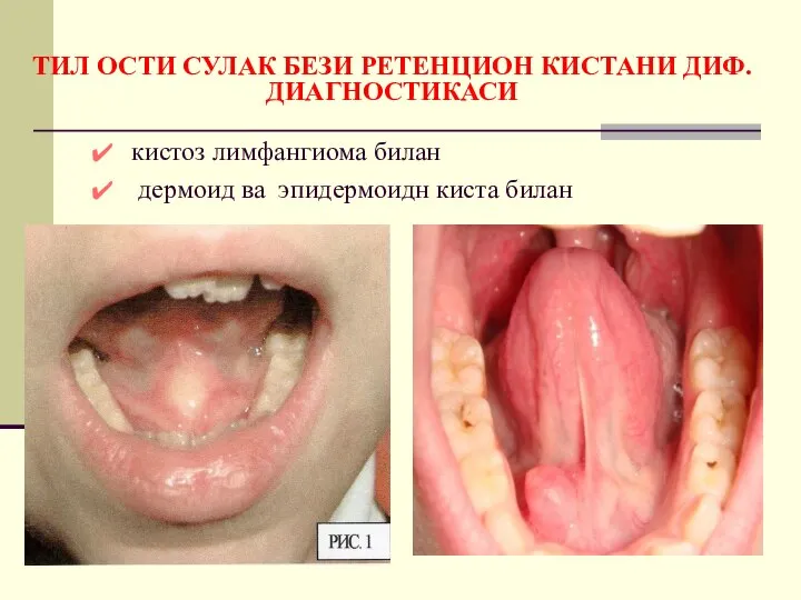 ТИЛ ОСТИ СУЛАК БЕЗИ РЕТЕНЦИОН КИСТАНИ ДИФ. ДИАГНОСТИКАСИ кистоз лимфангиома билан дермоид ва эпидермоидн киста билан