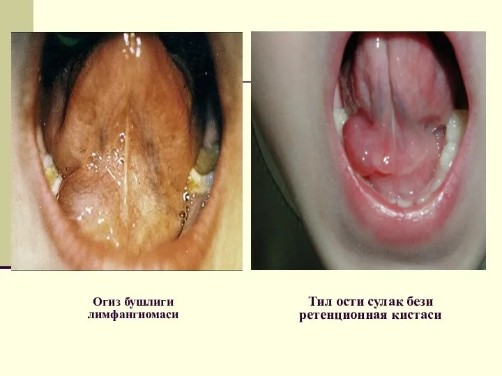 Огиз бушлиги лимфангиомаси Тил ости сулак бези ретенционная кистаси