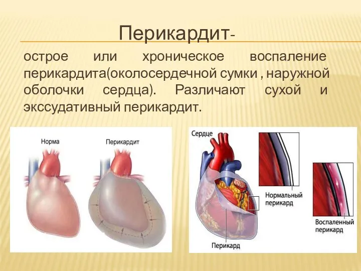 Перикардит- острое или хроническое воспаление перикардита(околосердечной сумки , наружной оболочки сердца). Различают сухой и экссудативный перикардит.