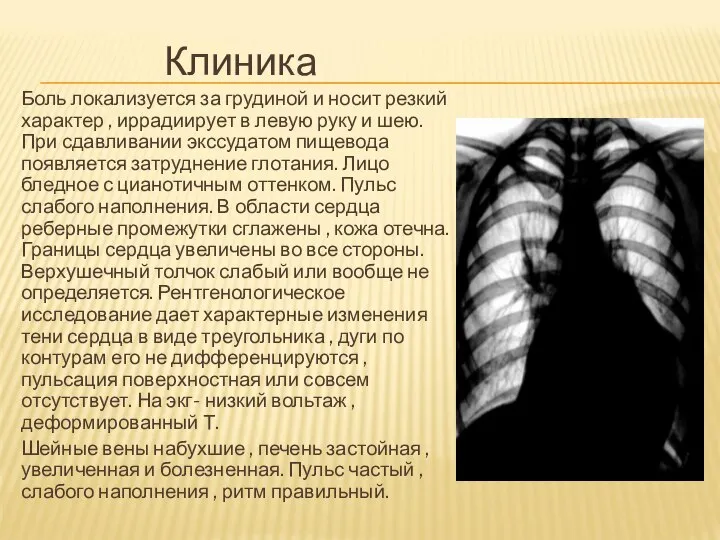 Клиника Боль локализуется за грудиной и носит резкий характер , иррадиирует в