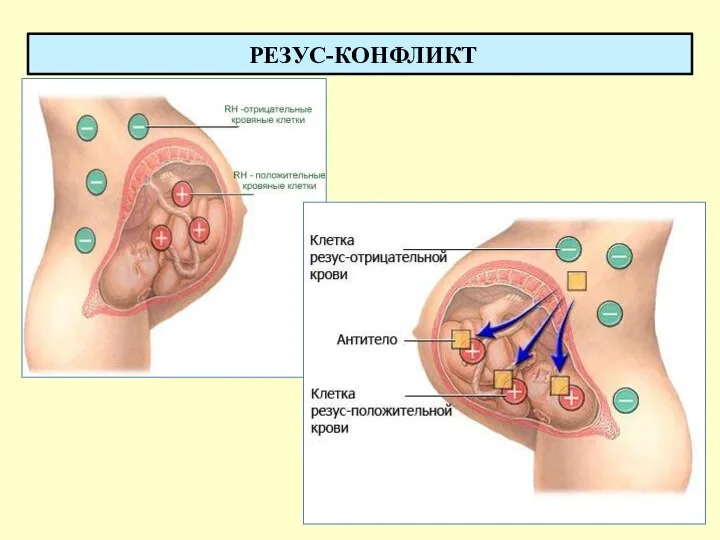 РЕЗУС-КОНФЛИКТ