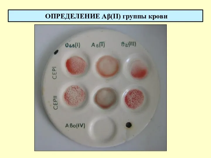 ОПРЕДЕЛЕНИЕ Aβ(II) группы крови