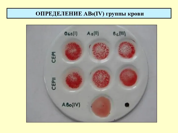 ОПРЕДЕЛЕНИЕ AB0(IV) группы крови