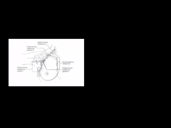 Лимфоотток Лат. аксиллярные Мед. Аксиллярные Парастернальные Надключичные