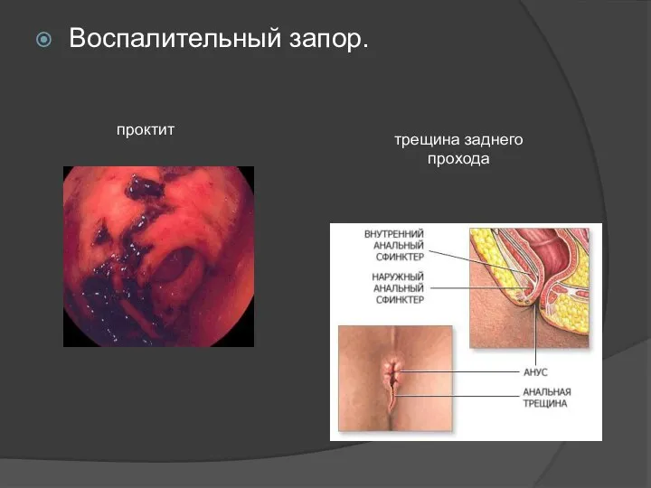 Воспалительный запор. проктит трещина заднего прохода