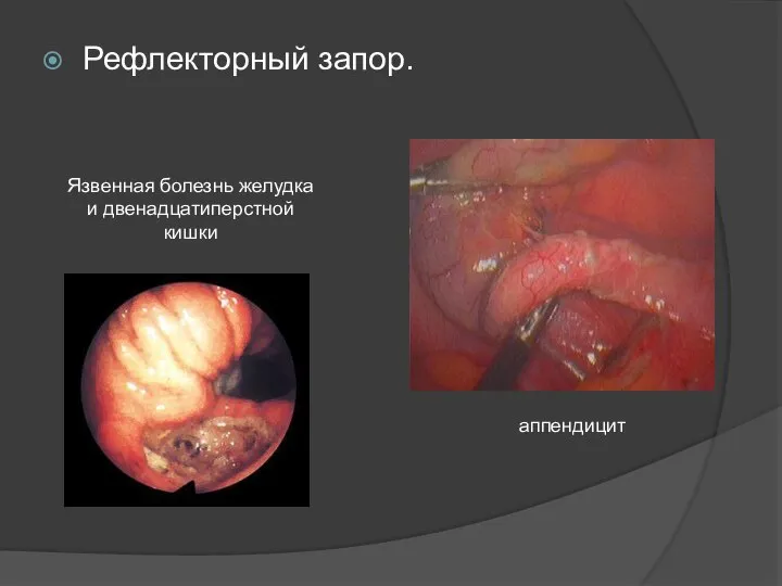Рефлекторный запор. аппендицит Язвенная болезнь желудка и двенадцатиперстной кишки