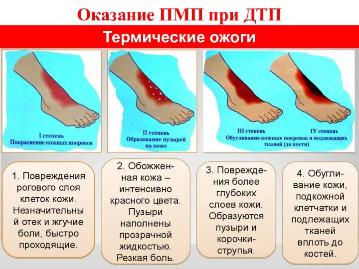 Оказание ПМП при ДТП Термические ожоги