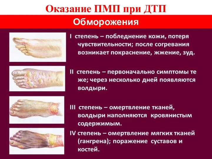 Оказание ПМП при ДТП Обморожения