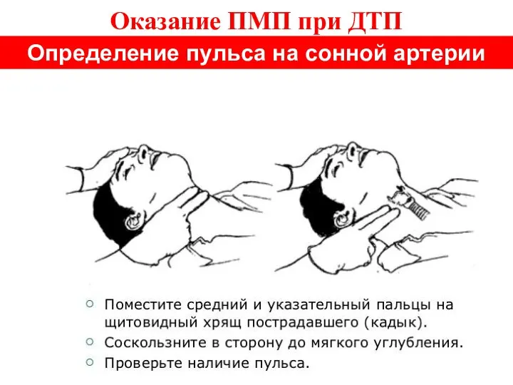 Оказание ПМП при ДТП Определение пульса на сонной артерии