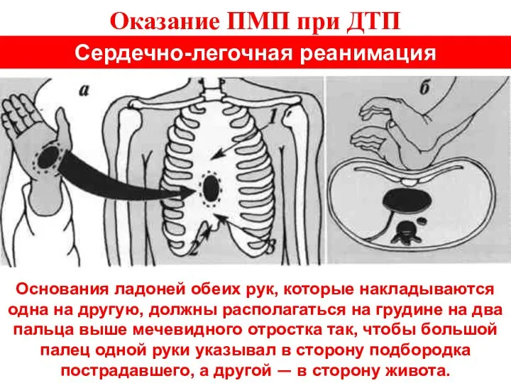 Оказание ПМП при ДТП Сердечно-легочная реанимация Основания ладоней обеих рук, которые накладываются