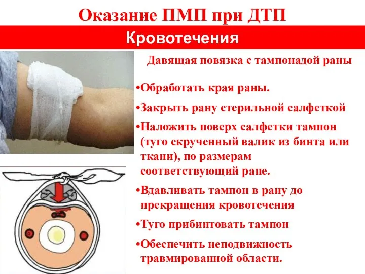 Оказание ПМП при ДТП Кровотечения Обработать края раны. Закрыть рану стерильной салфеткой