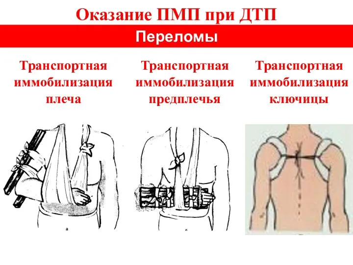 Оказание ПМП при ДТП Переломы Транспортная иммобилизация плеча Транспортная иммобилизация ключицы Транспортная иммобилизация предплечья