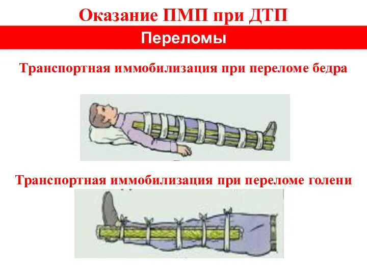 Оказание ПМП при ДТП Переломы Транспортная иммобилизация при переломе бедра Транспортная иммобилизация при переломе голени