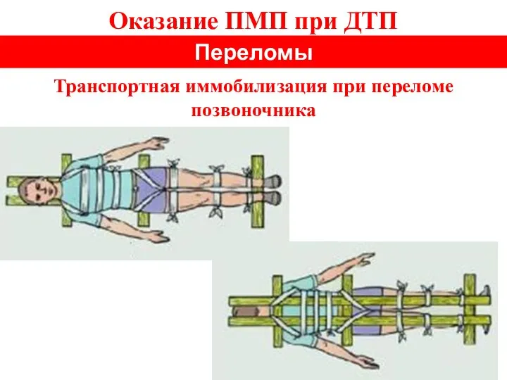 Оказание ПМП при ДТП Переломы Транспортная иммобилизация при переломе позвоночника