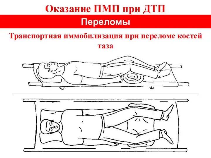 Оказание ПМП при ДТП Переломы Транспортная иммобилизация при переломе костей таза