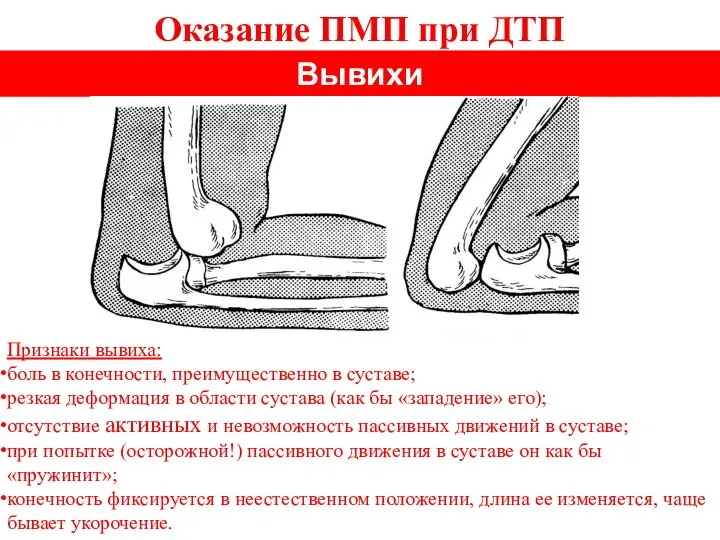 Оказание ПМП при ДТП Вывихи Признаки вывиха: боль в конечности, преимущественно в