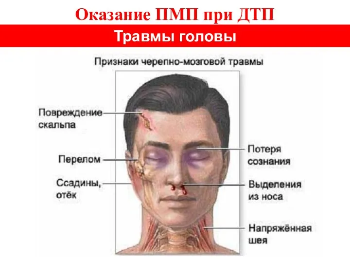 Оказание ПМП при ДТП Травмы головы